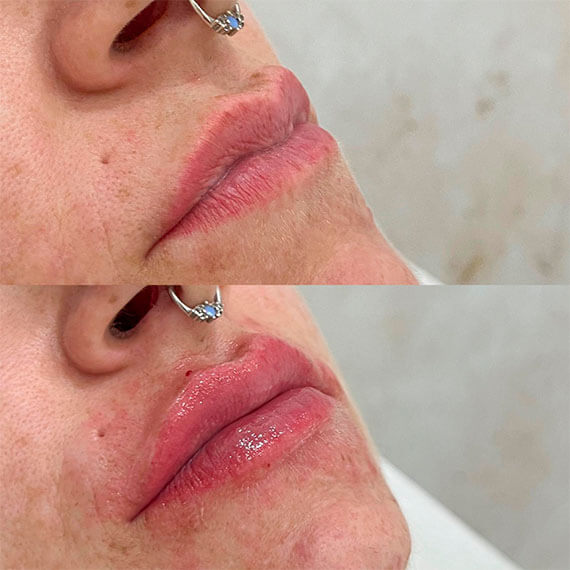 Aplicación de Rellenos faciales en Cancún