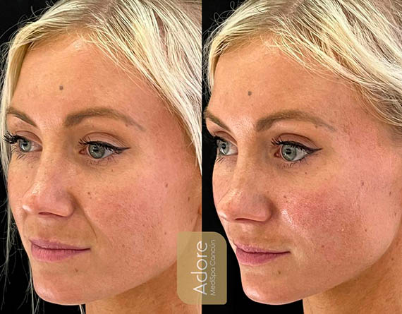 Liquid Facelift Results Cancun