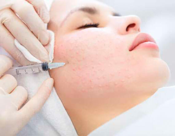 Dermal Fillers in Cancun